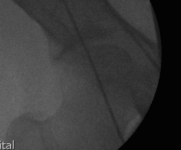 HTO Diathermy Lead Femoral Head